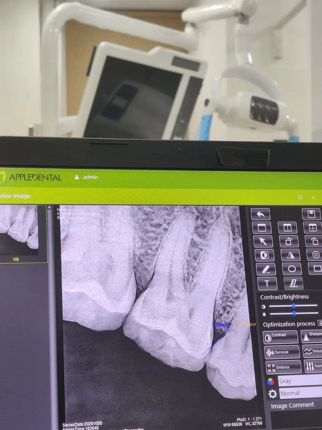 Digital dental radiograph displayed in the OralMedix treatment room